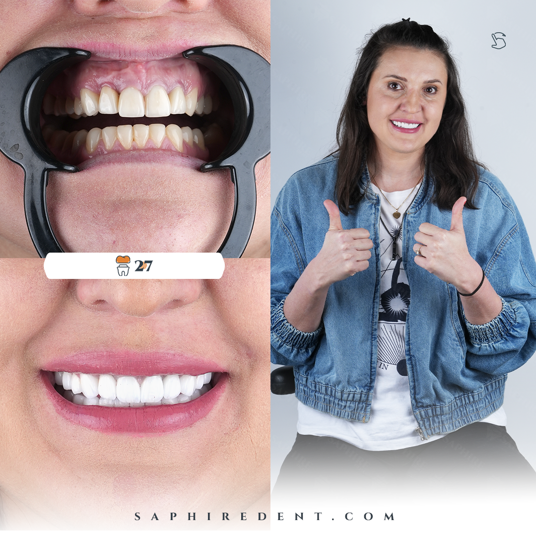 Dental Crowns